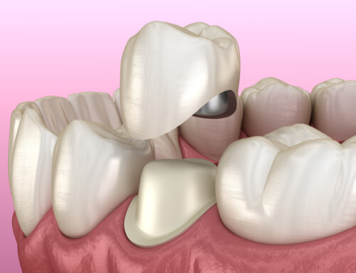 Faccette dentali e corone